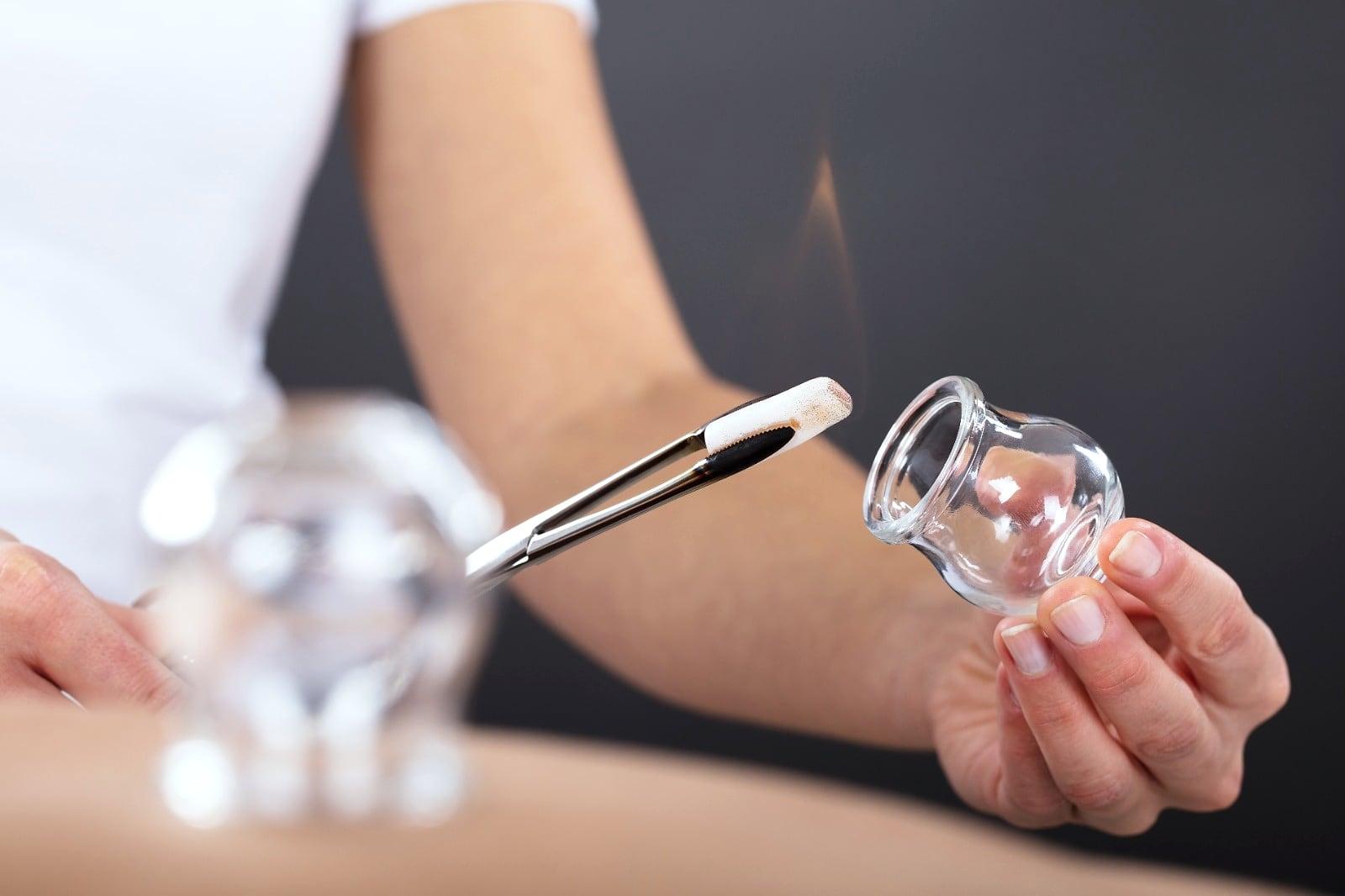 Nahaufnahme vor dem Setzen: In einem Schröpfglas wird mit einer kurzen Flamme an der Pinzette der Unterdruck erzeugt